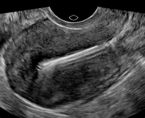 Accurate Detection Of Iud Placement Using 3d Ultrasound Sononotes