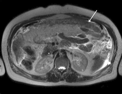 Abdominopelvic Magnetic Resonance Imaging Axial T2 Weighted Image