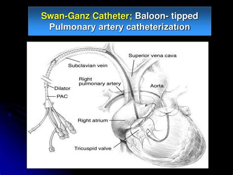 Swan Ganz Catheter Anatomy