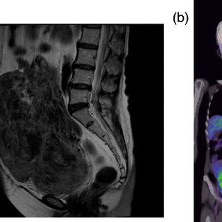 Radiological Images A Pelvic Magnetic Resonance Imaging T2 Enhanced