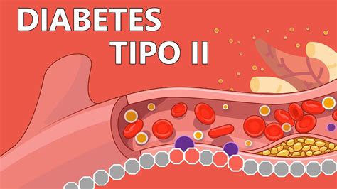 Diabetes Tipo 2 Explicada Fácilmente Para Pacientes Youtube