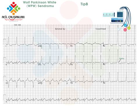 Wolf Parkinson White Wpw Sendromu Acil Çalışanları