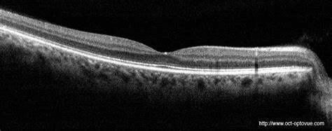 Tomographie Par Coh Rence Optique Oct Centre Ophtalmologique C Te