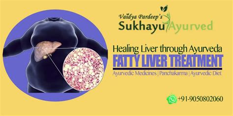 Ayurvedic Treatment For Fatty Liver Ayurveda For Fatty Liver