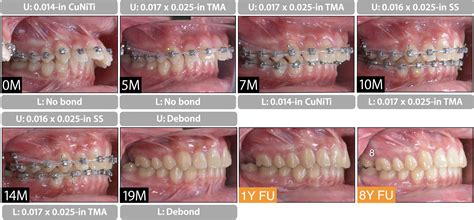 Class Ii Malocclusion With Severe Overjet Treated With Maxillary Second