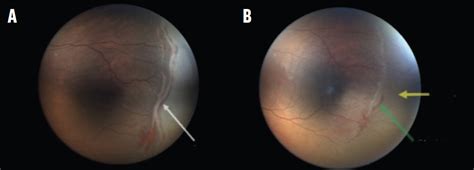 Icrop Updates Reactivation And Regression Retina Today