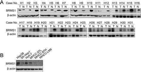 Pdf Breast Cancer Metastasis Suppressor 1 Regulates Hepatocellular