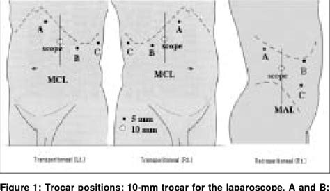 Figure 1 From Laparoscopic Adrenalectomy Semantic Scholar