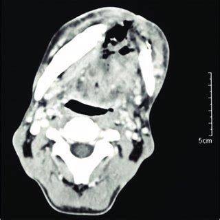 Extensive myiasis localised within cancerous wound. | Download ...