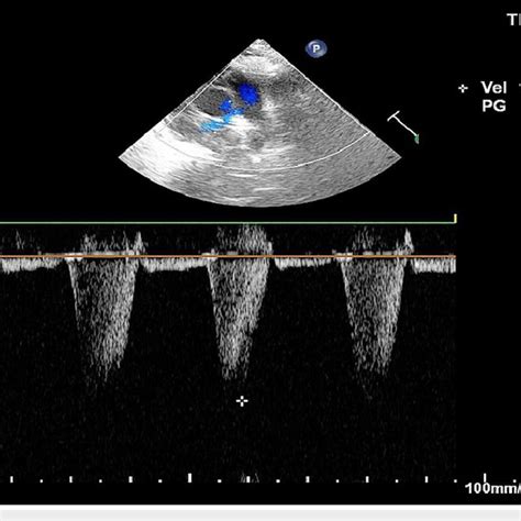 Aortic Dissection Ultrasound