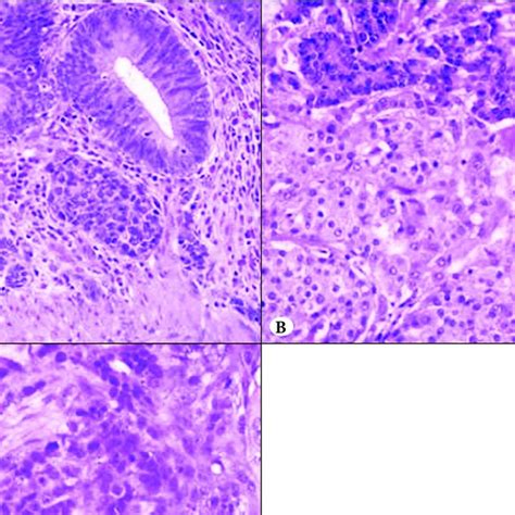 A Well Differentiated Neuroendocrine Tumor Wd Net Composed Of Download Scientific Diagram