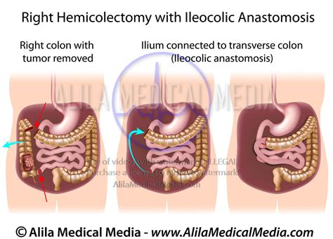 Alila Medical Media Oncology Images And Videos