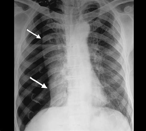 Pneumothorax Lung X Ray