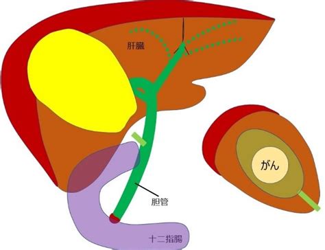 胆道がんの治療 国立がん研究センター 中央病院