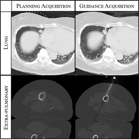 Lung Nodule Biopsy With Low Dose Ct Guidance Protocol Single Images Download Scientific