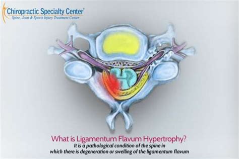 Ligamentum Flavum Hypertrophy | Cause & Treatment