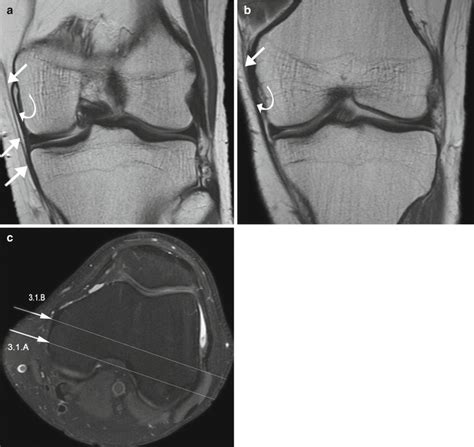 Medial Collateral Ligament Mcl And Medial Supporting Structures