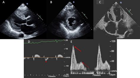 Amyloid Heart Disease Module 1 Diagnosis