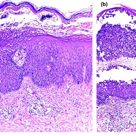 A B Generalized Pustular Psoriasis Showing Epidermal Hyperplasia