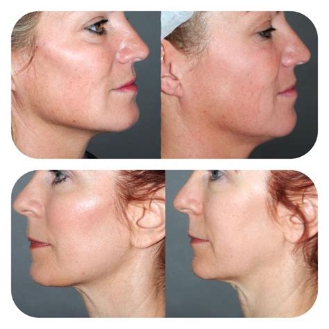 Liquid Face Lift Cosmetic Surgery Cheekbones Augmentation Cheekbone