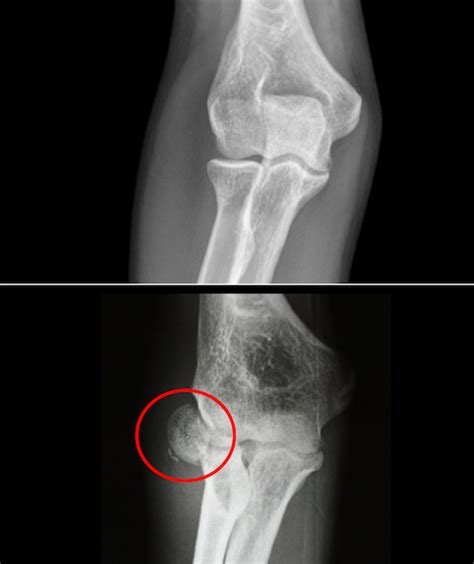 Radial head fracture