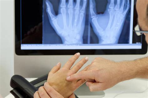 Metacarpal Fracture Treatment Melbourne Gippsland