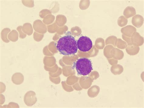 Acute Megakaryoblastic Leukemia Amkl M7 Flow Cytometry