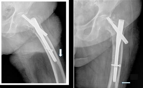 Intertrochanteric Fracture Associated With Undiagnosed Ipsilateral