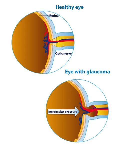 2051 Glaucoma Vector Images Glaucoma Illustrations Depositphotos