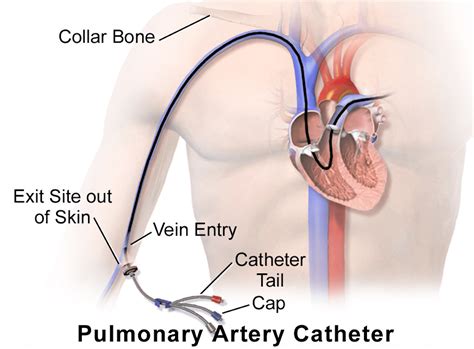 Swan Ganz Catheter An Overview 2023 56 Off