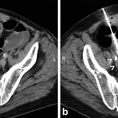 Ct Guided Transenteric Needle Biopsy Of A Pelvic Ln A A 67 Year Old Download Scientific