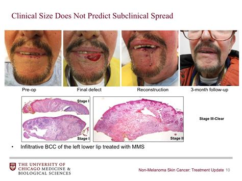 Lip Cancer Treatment - CancerWalls