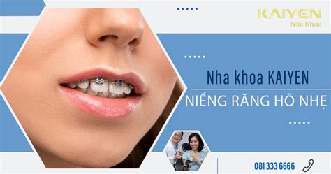 Giá niềng răng răng hô nhẹ niềng mất bao nhiêu tiền