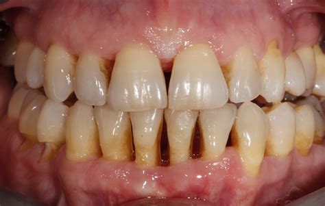 Caso De éxito Enfermedad Periodontal Tratada Con Ortodoncia Invisible