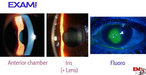 Emdocs Net Emergency Medicine Educationemin Slit Lamp Anatomy