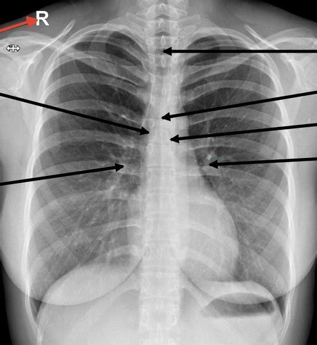 A P Lab X Rays Flashcards Quizlet