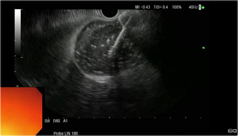 Transjejunal Ercp Eus Guided Gallbladder Drainage And Cholecystoscopy