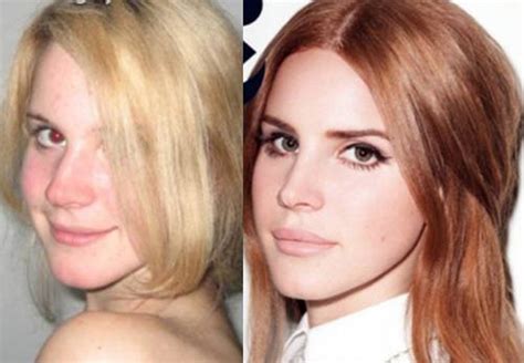 Lana Del Rey Before And After Plastic Surgery