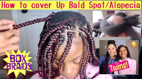 Update How To Cover Up Bald Spot Alopecia Box Braids Progress Youtube