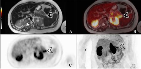 A 14-year-old boy with hyperinsulinemia is being evaluated for ...