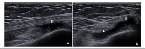 Figure From A Case Study Of Baker Cysts With Intramuscular Extension