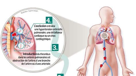 L embolie pulmonaire mieux diagnostiquée