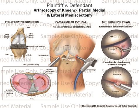 Arthroscopy Of Knee Partial Medial Lateral Meniscectomy Motionlit