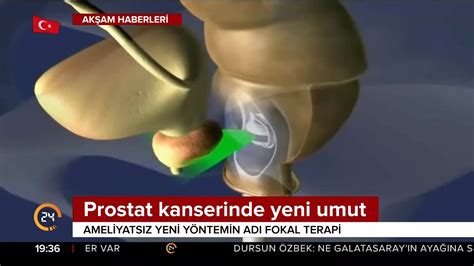 Prostat Kanserinde Hifu Ile Fokal Terapi Haber