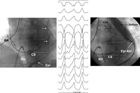 Epicardial Interventions In Electrophysiology Abstract Europe Pmc