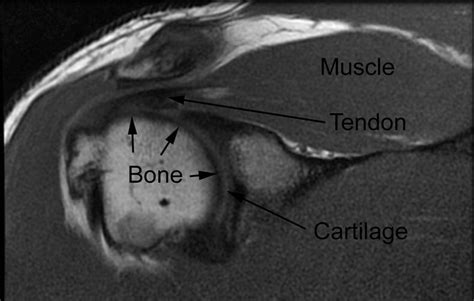 Shoulder Mri Without Contrast