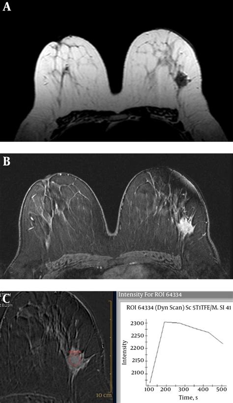 Luminal A Breast Cancer Invasive Ductal Carcinoma Of The Left Breast