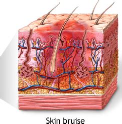 Excessive Bruising on Legs for No Reason Causes, Anemia, in Children ...