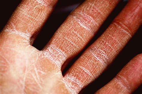 Mayo Clinic Minute Eczema Occurs In People Of All Ages