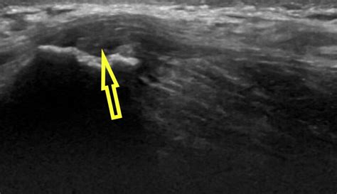 Tensor Fasciae Latae Pain: Causes, Symptoms, and Solutions